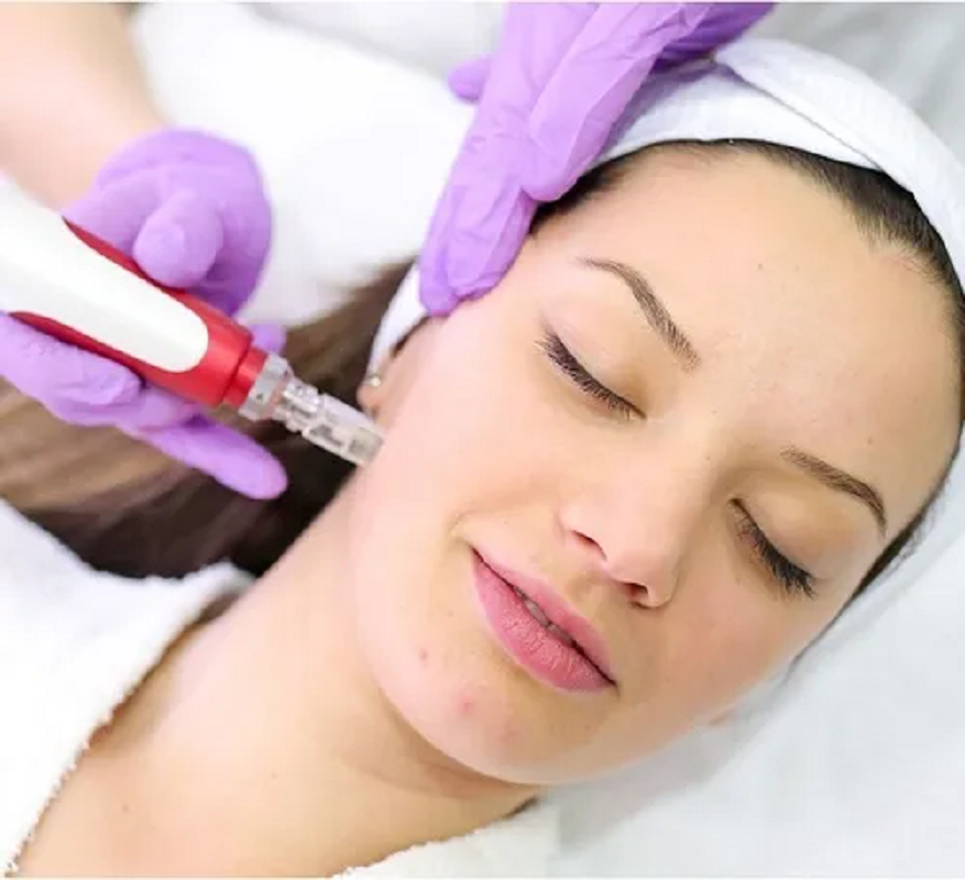 Dermapen Profesional para Cicatrices de Acné – Recupera Tu Piel en Casa