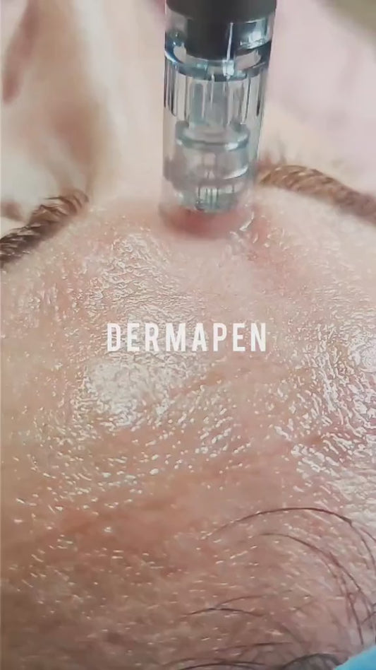 Dermapen Profesional para Cicatrices de Acné – Recupera Tu Piel en Casa
